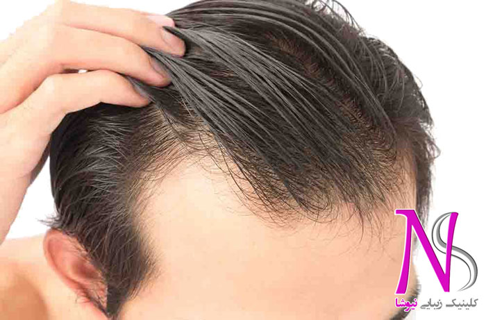 علت استفاده از کاشت مو